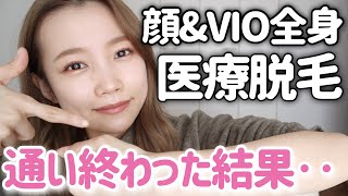 【本気解説】顔・VIO込み全身の医療脱毛通い終わった結果。硬毛化や痛み、効果について◎