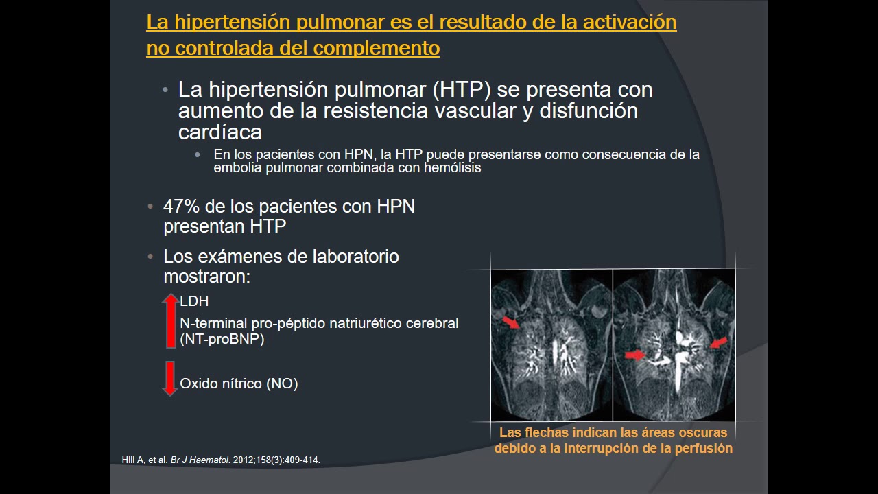 Clasificación de hipertensión pulmonar 2020 esquivar Clasificación de hipertensión pulmonar 2020 esquivar