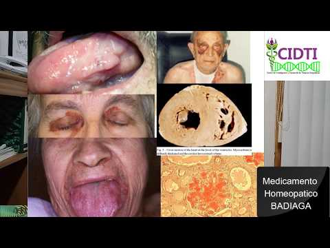 Vídeo: Tratamiento De La Amiloidosis Con Remedios Y Métodos Populares