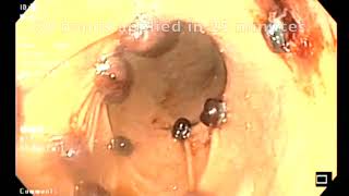ENDOSCOPIC BAND LIGATION FOR WEIGHT LOSS 2023