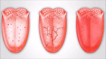 Welche Krankheiten kann man an der Zunge erkennen?