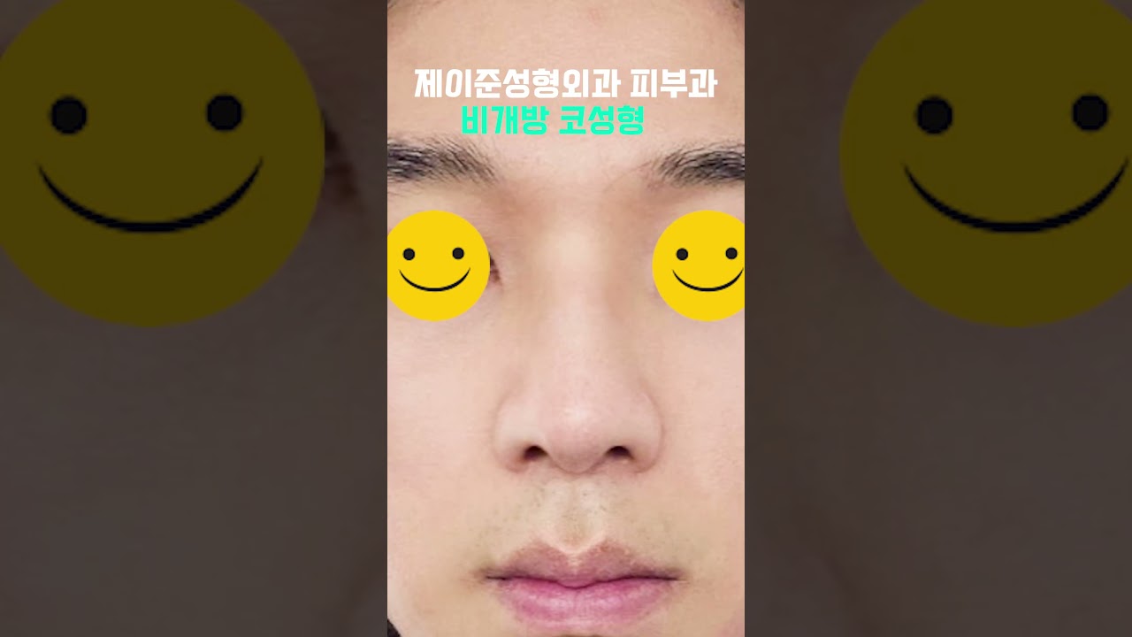 [JAYJUN PHẪU THUẬT THẨM MỸ DA] Chỉ cần nâng chóp mũi thôi là đã khác hẳn rồi! 👃So sánh trước và sau phẫu thuật (Nâng mũi kín) #shorts