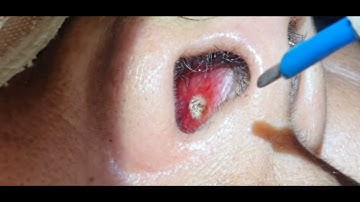 Epistaxis , Cautery / Nose Bleed - Dr Hitesh Patel