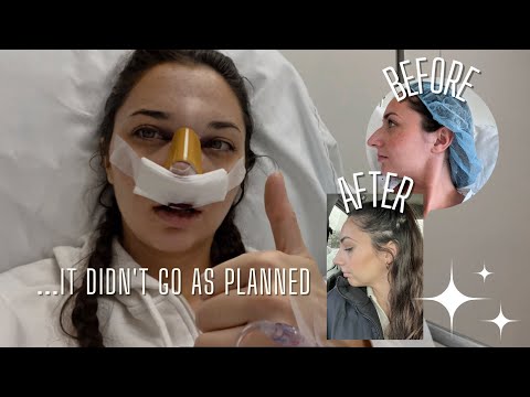 Video thumbnail: I got a nose job *in secret* and vlogged the process