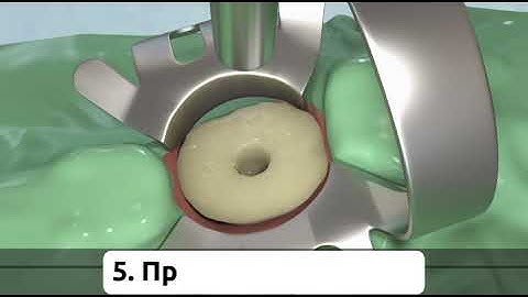 Spident - Core it Dual - Build-up