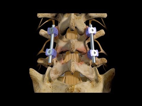 L4-5 Posterior Interbody Fusion