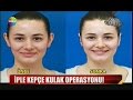 9,5 dakikada kepçe kulak operasyonu