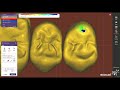 #exocad 2 anatomic bridge. How to Install Exocad DentalCAD | Full License Activation Guide chemnitz