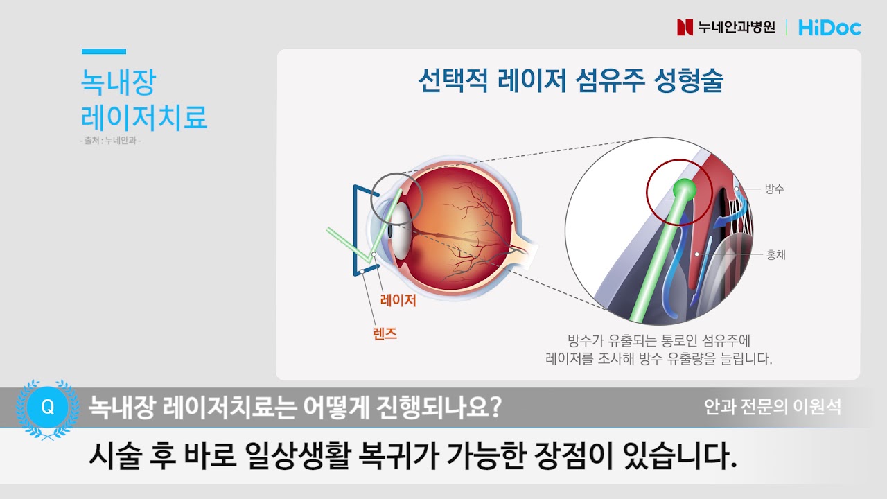 녹내장 레이저치료는 어떻게 진행되나요 / 누네안과병원 녹내장센터 이원석 원장 - YouTube