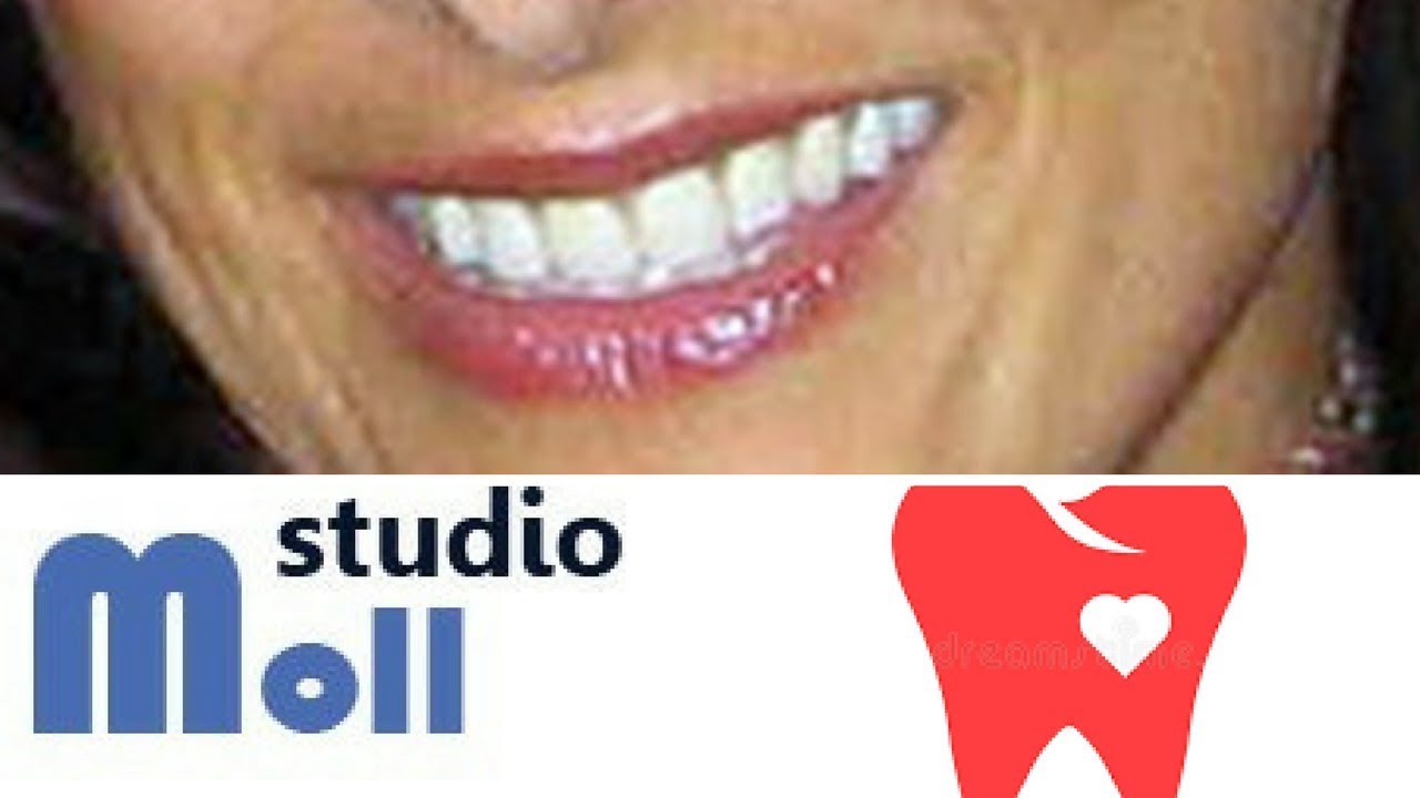 Perché il tartaro ritorna sempre tra i denti? 3 Ragioni.