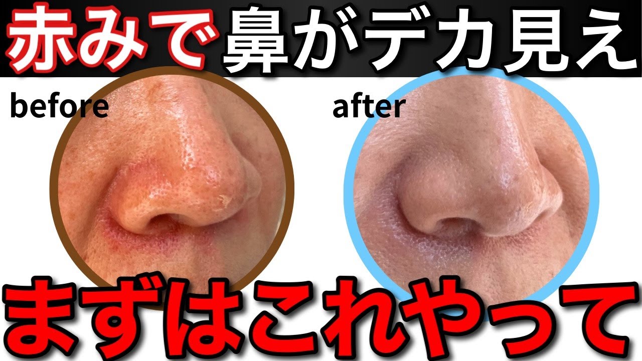 鼻の赤みは冬の乾燥が原因なので、スキンケア＋ファンデで綺麗に隠せます！