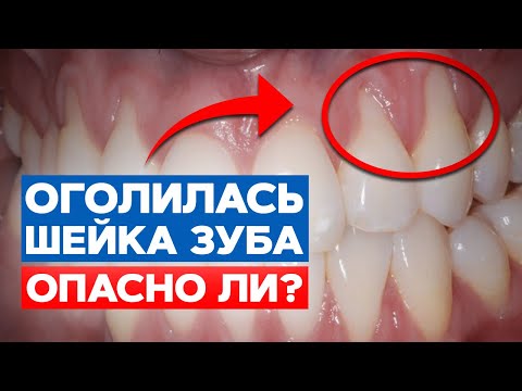 Зубы кровоточат и видно корень зуба! Что делать? / Рецессия десен — причины, симптомы, лечение!