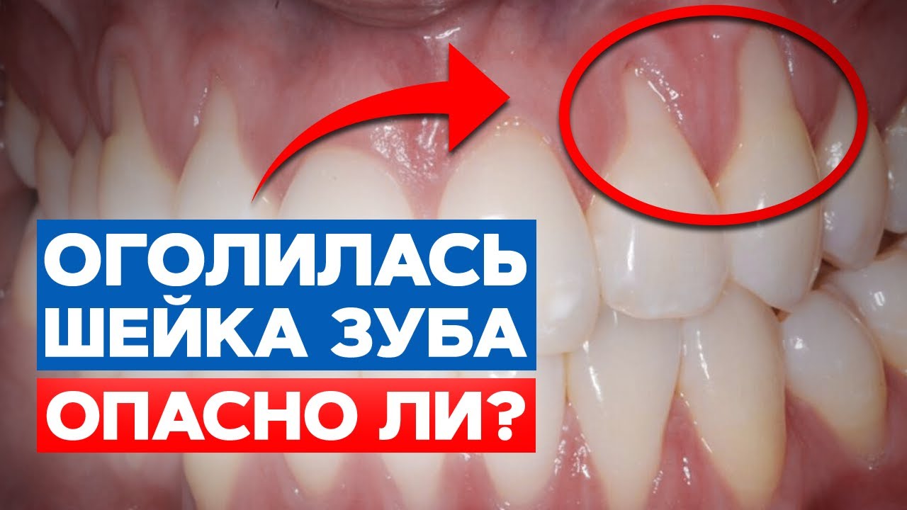 Зубы кровоточат и видно корень зуба! Что делать? / Рецессия десен ...