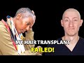 My Hair Transplant Did Not Work | Hair Surgeon Reacts