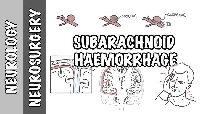 Subarachnoid Hemorrhage (SAH) - Willis-Knighton Health System