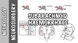 Subarachnoid Haemorrhage / pathophysiology, complications and management by Armando Hasudungan 56,020 views 1 year ago 11 minutes, 43 seconds