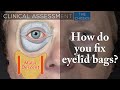 65 yo Female with Lower Eyelid Bags & Periorbital Aging | Aesthetic Minutes #EyelidBags