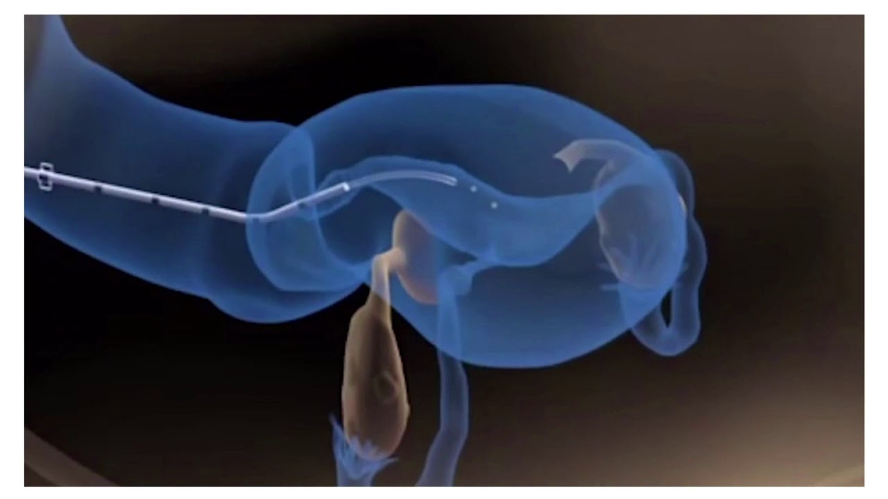 5 هذا الفلم يعرضعمليّة إرجاع الأجنّة إلى الرحم