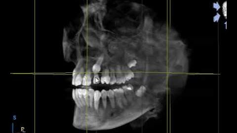 3D View of CBCT
