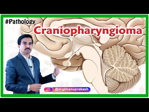 Craniopharyngioma Quick review  - Pathology USMLE Step 1