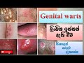 Genital warts/ ලිංගික ඉන්නන්/ how it happens/ causes/ symptoms/ treatment/ how to prevent