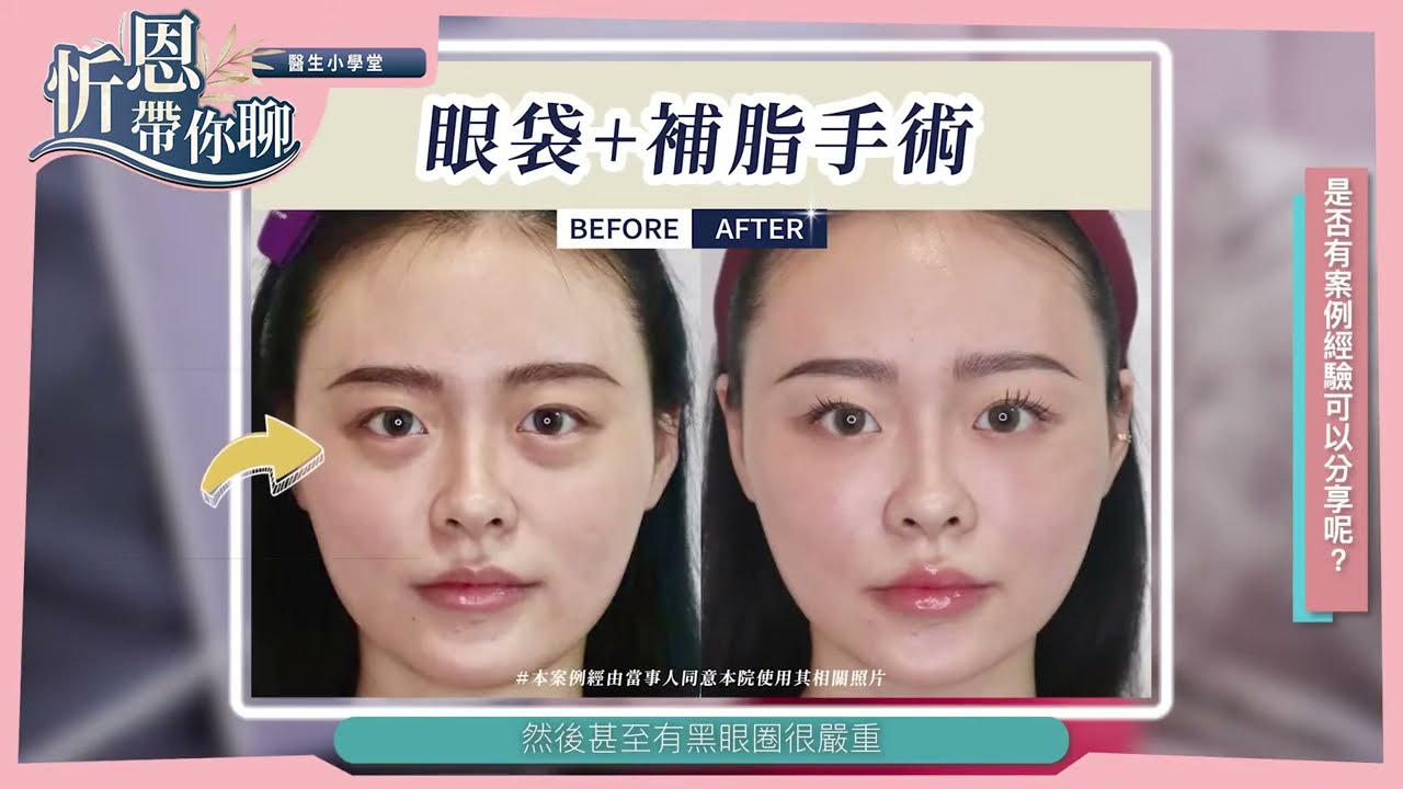 姚勝發醫師小學堂【掰掰顯老眼袋！