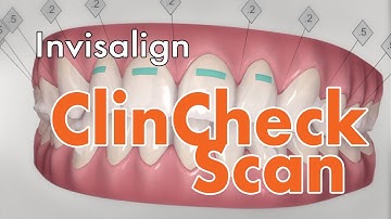 Invisalign ClinCheck Scan- 3Dental