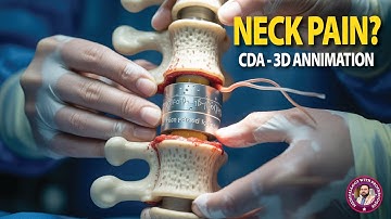 3D Animation of Cervical Disc Arthroplasty (CDA) – Symptoms, Causes & Treatment Options