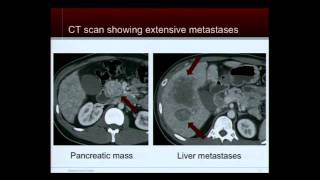 Tumor Board Case Discussions: Neuroendocrine Tumor Patient Education Conference