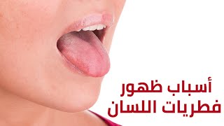 أسباب ظهور فطريات اللسان