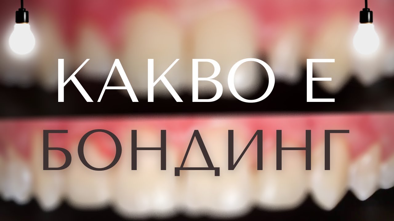 Бондинг на предни зъби | Микродонтия