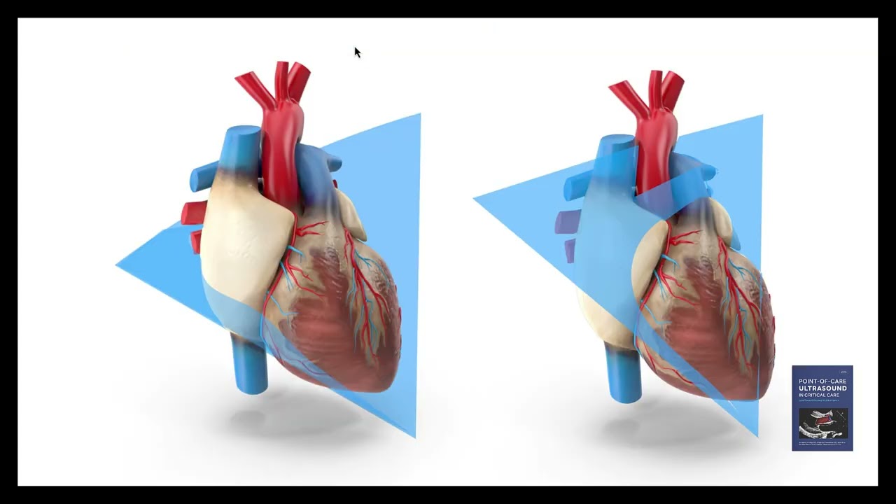 5 Essential Views in Focused Cardiac Ultrasound (FOCUS)