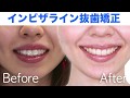 インビザライン 小臼歯４本抜歯【最適アタッチメント】出っ歯を治したい