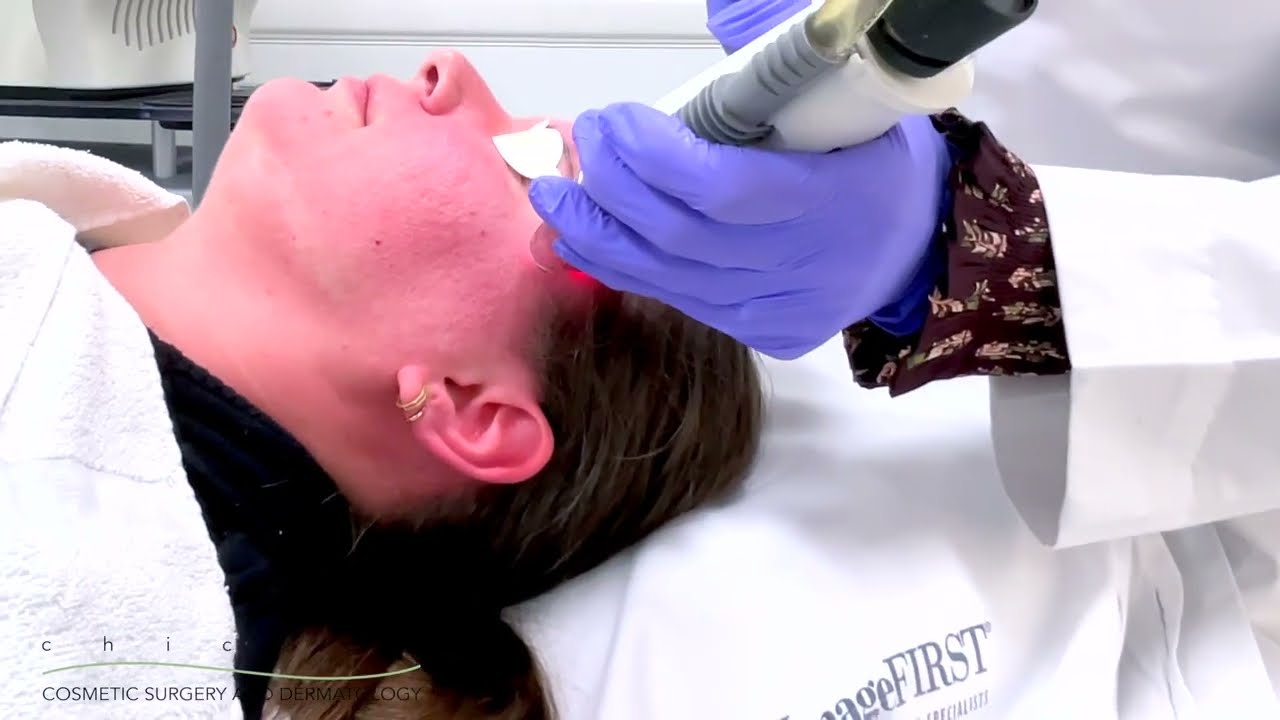 Fraxel Dual Laser Resurfacing