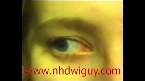Horizontal Gaze Nystagmus (HGN) - DUI Field Sobriety Eye Test