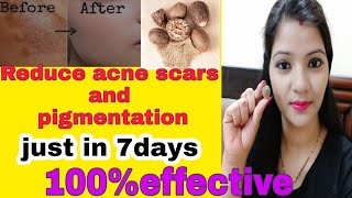 7days challenge remove acne scars , pigmentation with nutmeg //jayfal face pack for glowing skin