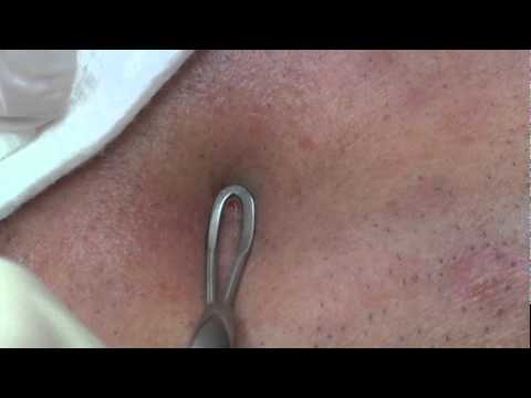 Professional Pimple Pop! (Part 2) - YouTube