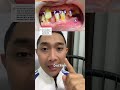SINUSITIS KARENA SISA AKAR GIGI RAHANG ATAS‼️ ADA BERAPA SISA AKAR GIGIMU🫣 #sinusitis #sisaakargigi