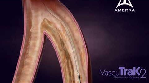 IDev VascuTrak - 3D Medical Device Animation