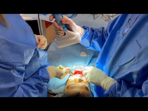 Lower Fully guided All on X surgery and digital workflow