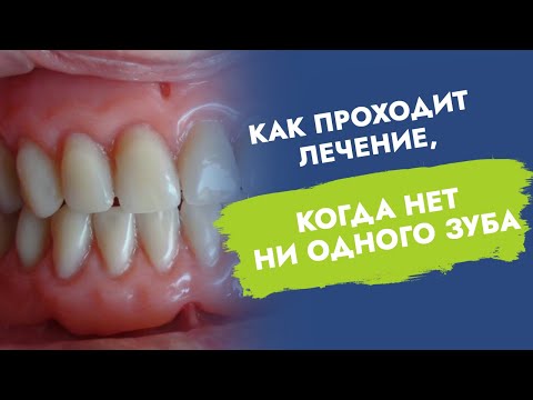 Не осталось ни одного зуба. Полные съёмные протезы. Как проходит лечение?