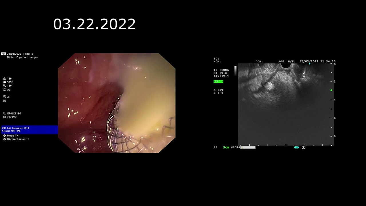 Sigmoïdite  aiguë abcédée un nouveau traitement endoscopique ( par coloscopie) sans chirurgie.