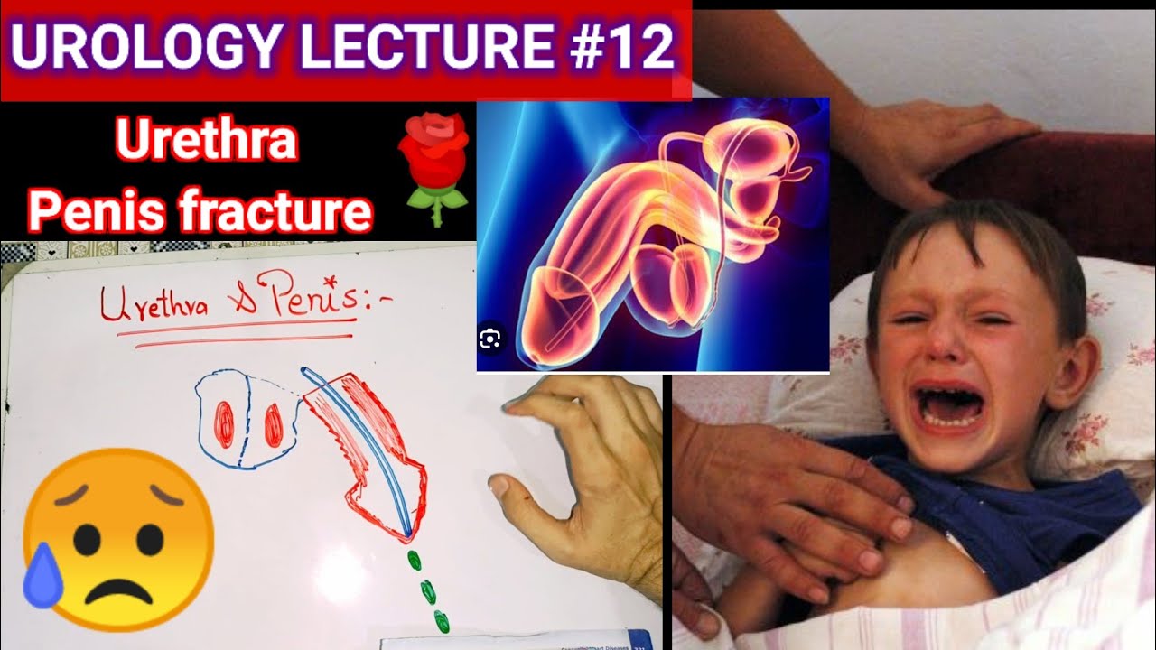 🏁 Operation for phimosis Kyiv, what is phimosis, treatment, symptoms,  stages, causes, consequences, circumcision for phimosis, clinic of urology  Kyiv, Urological practice