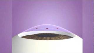 Laser Thermal Keratoplasty Ltk