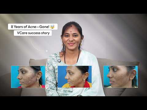 Best Acne & Pimple Treatment in Bangalore | #salicylicpeel | Ashwini’s #VCare Success Story"