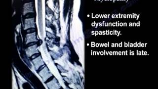 Cervical Spine Myelopathy   Everything You Need To Know   Dr  Nabil Ebraheim
