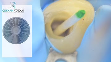 Broken File Removal / BTR Pen from Cerkamed