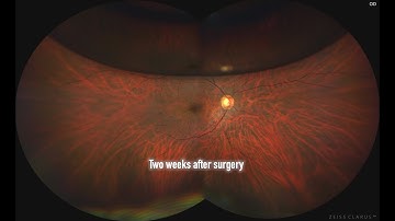 Vitrectomy for total rhegmatogenous retinal detachment