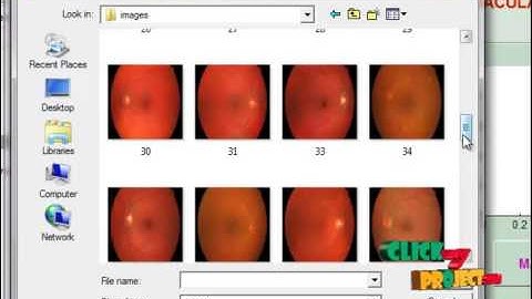 Final Year Projects | Using artificial neural network in a computer aided diagnosis system for