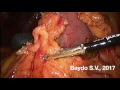 Laparoscopic D2 total gastrectomy with hard LND of 10 station